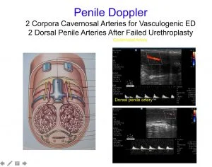 penile-doppler-300x236-1